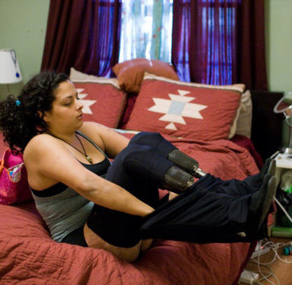 Jamie Schanbaum on her bed putting her pants on over her prosthetics.