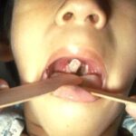 A doctor working in a child's mouth, showing pharyngeal diphtheria with membranes covering the tonsils and uvula.