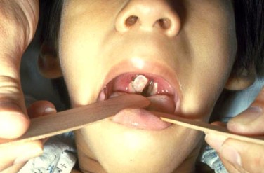 A doctor working in a child's mouth, showing pharyngeal diphtheria with membranes covering the tonsils and uvula.