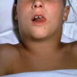 A young boys face and upper chest showing the “bull neck” appearance of diphtheritic cervical lymphadenopathy.