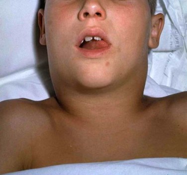 A young boys face and upper chest showing the “bull neck” appearance of diphtheritic cervical lymphadenopathy.