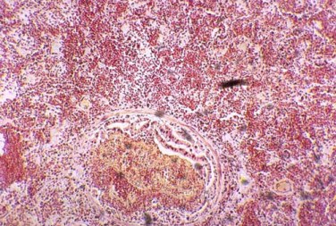 Close-up of diphtheria pneumonia (hemorrhagic) with bronchiolar membranes.