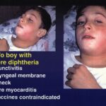 A 10-year-old child with severe diphtheria. Also: conjunctivitus, pharyngeal membrane, bull neck, severe myocarditis, all vaccines contraindicated.