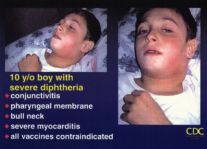 Diphtheria Photos Vaccine Information