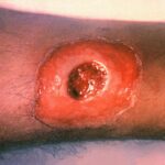 Close up of a diphtheria skin lesion on the leg.