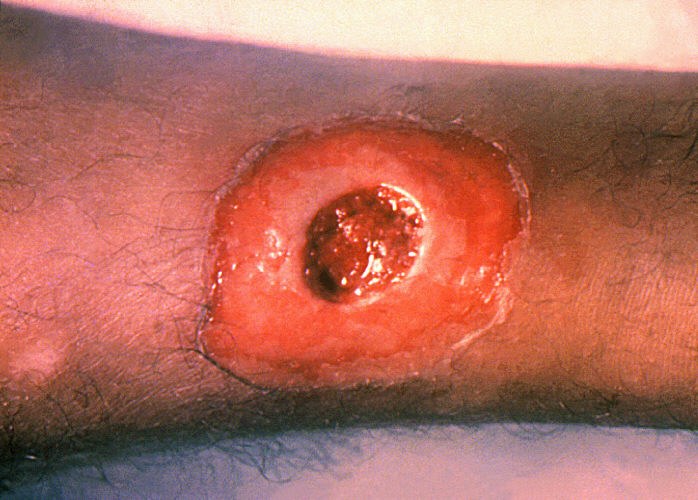 Close up of a diphtheria skin lesion on the leg.