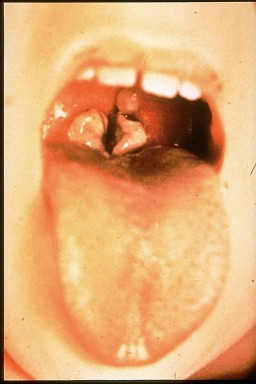 The open mouth of a child with diphtheria, shown by the thick gray coating over the back of the throat.