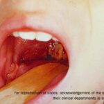 The open mouth of a child with a tongue depressor, showing signs of diphtheria, pseudomembrane.