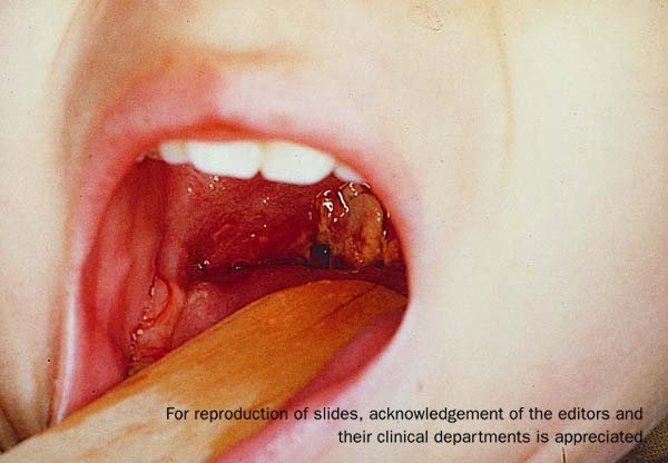 The open mouth of a child with a tongue depressor, showing signs of diphtheria, pseudomembrane.