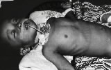 An Indonesian child with diphtheria laying on a bed with neck bandages, kept alive by a throat operation.