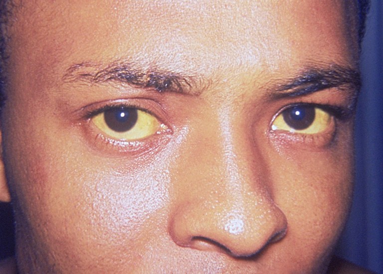 In a facial closeup, hepatitis A is manifested here as icterus, or jaundice of the conjunctivae and facial skin.