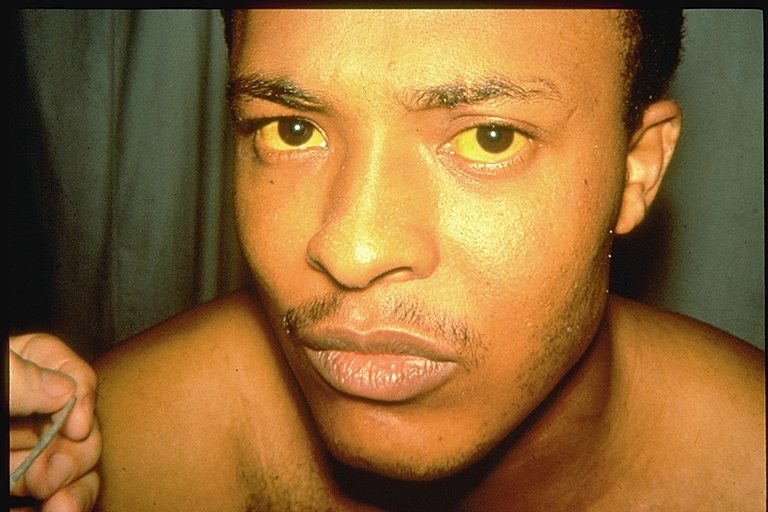 Face of a man with jaundice, shown by yellowing of the skin and eyes.