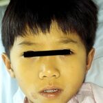Face of a young child with hepatitis A.