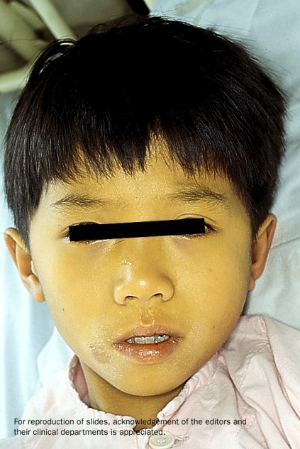 Face of a young child with hepatitis A.