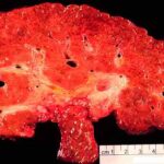Section of liver damaged by HBV, showing enlarged cells and blistering of the capsular surface.