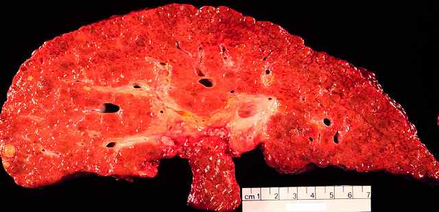 Section of liver damaged by HBV, showing enlarged cells and blistering of the capsular surface.