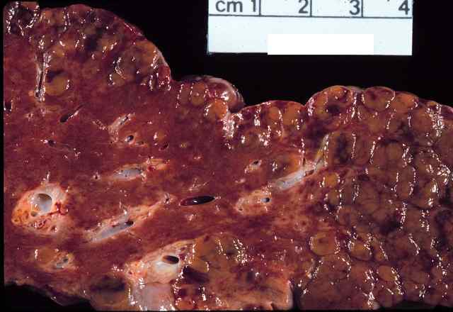 Second view of section of liver damaged by HBV, showing enlarged cells and blistering of the capsular surface.