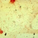 Cerebrospinal fluid culture positive for Haemophilus influenzae, type b (Gram stain).