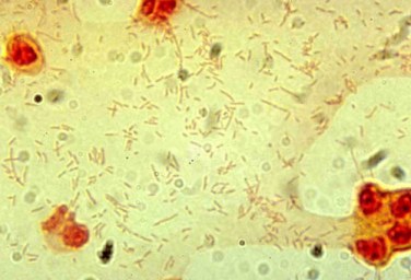 Cerebrospinal fluid culture positive for Haemophilus influenzae, type b (Gram stain).