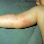 The right arm of a young child with Hib showing rash and inflammation.