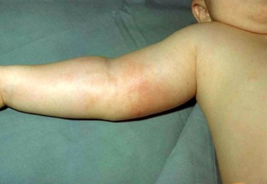 The right arm of a young child with Hib showing rash and inflammation.