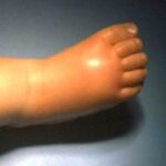 The right foot of a young child with Hib showing rash and inflammation.