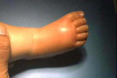 The right foot of a young child with Hib showing rash and inflammation.