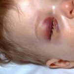 A young child sick from Hib showing inflamed eye area, rash, and paleness.
