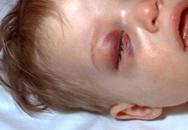 A young child sick from Hib showing inflamed eye area, rash, and paleness.