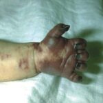 Infant's had showing severe vasculitis with disseminated intravascular coagulation (DIC) with gangrene secondary to Hib septicemia.