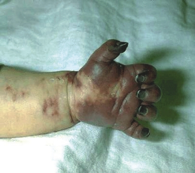 Infant's had showing severe vasculitis with disseminated intravascular coagulation (DIC) with gangrene secondary to Hib septicemia.