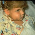 Young girl in bed with a with swollen face due to a Hib infection.