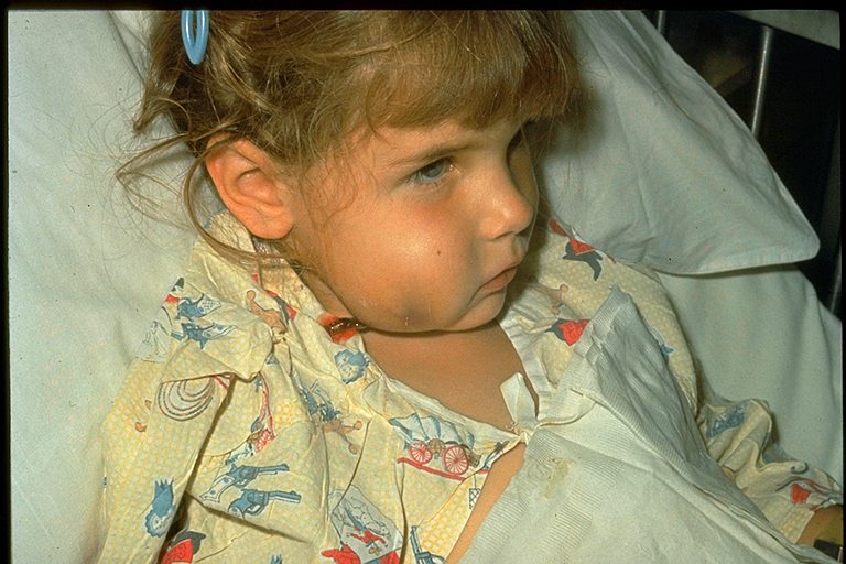 Young girl in bed with a with swollen face due to a Hib infection.