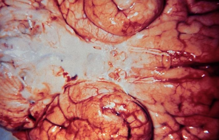 Inferior view of a brain infected with gram-negative Haemophilus influenzae bacteria.