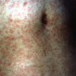 Extensive measles rash.