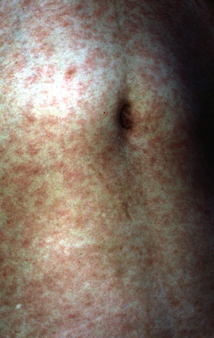 Extensive measles rash.