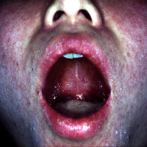 Koplik spots, which are blue-white spots on the inside of the mouth.