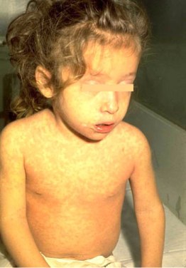 A miserable looking child suffering from rubeola.