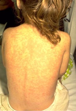 The back of a child suffering from rubeola.