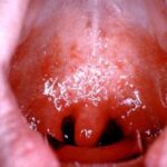 The open mouth of an adult showing striking inflammation from measles (rubeola) pharyngitis.