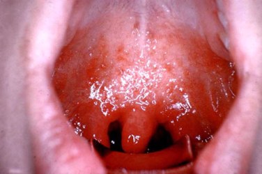 The open mouth of an adult showing striking inflammation from measles (rubeola) pharyngitis.