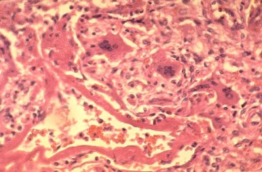 Close-up of measles (rubeola) bronchiolitis with marked air trapping.