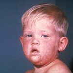 The face of a young blond boy with measles.