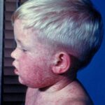 A side view of the head and shoulders of a boy with measles.