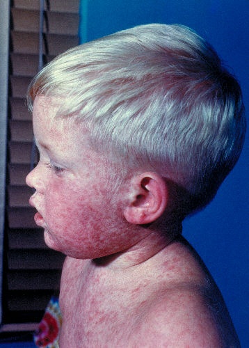 A side view of the head and shoulders of a boy with measles.