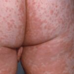 Characteristic red blotchy pattern on a child's buttocks during the third day of the measles rash.