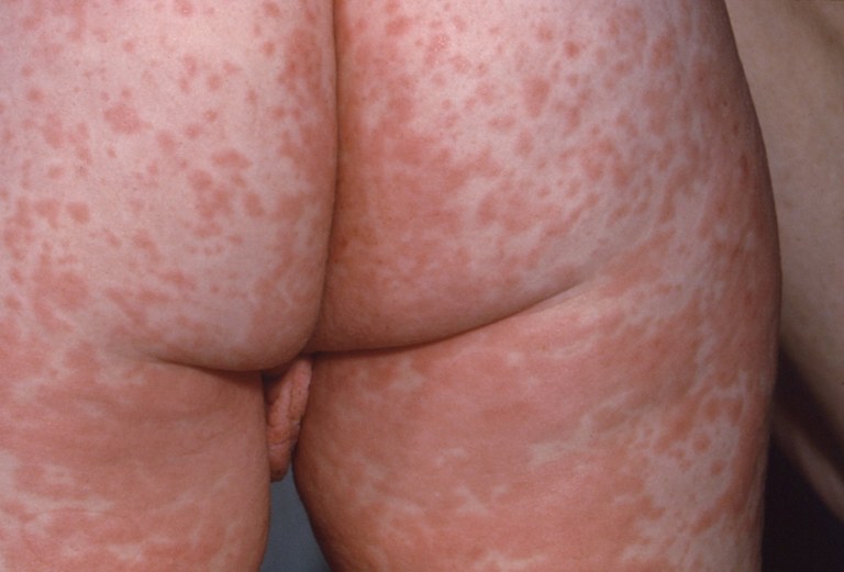 Characteristic red blotchy pattern on a child's buttocks during the third day of the measles rash.