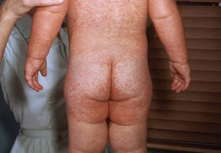 Characteristic red blotchy pattern on a child's back during the third day of the measles rash.