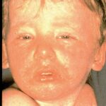 Child looking very weary, with a bad rash caused by measles.
