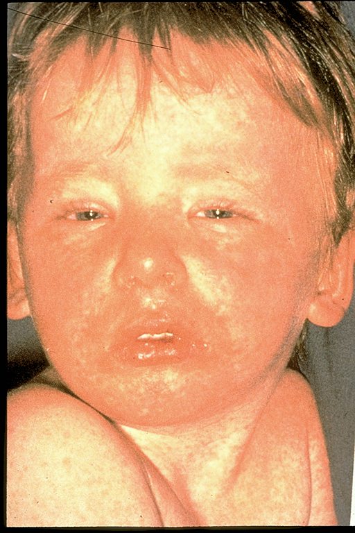 Child looking very weary, with a bad rash caused by measles.